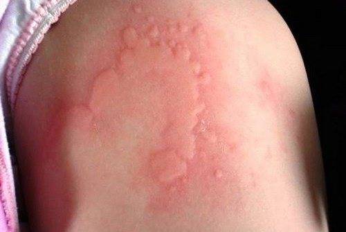 Как проявляется гастроинтестинальная форма пищевой аллергии у ребенка?