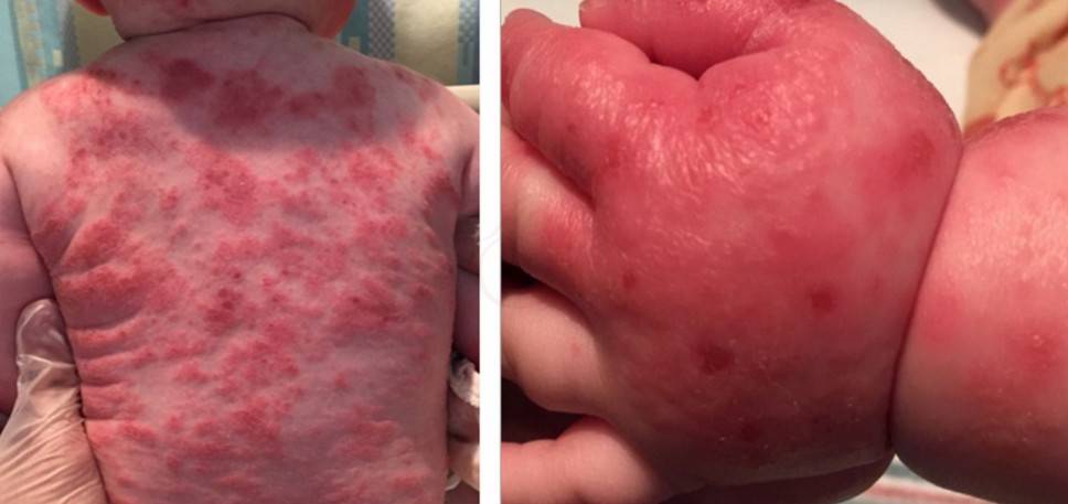 Сыпь после температуры у ребенка: фото, причины и лечение (Комаровский)