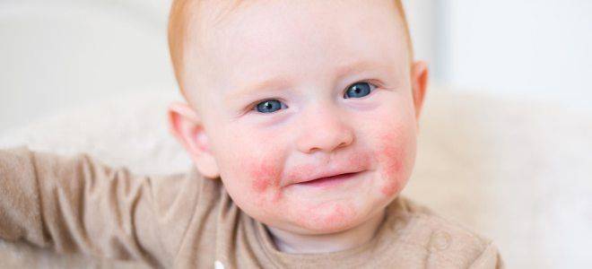 Как проявляется гастроинтестинальная форма пищевой аллергии у ребенка?