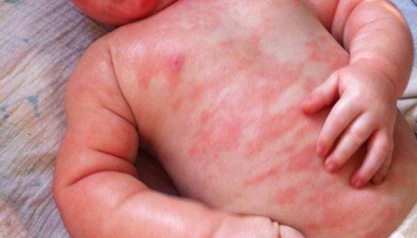Аллергия на антибиотики у ребенка - фото сыпи от приема лекарств, лечение