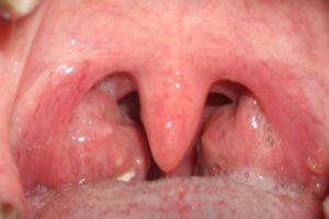 Чем лечить горло ???? при грудном вскармливании: таблетки кормящей маме