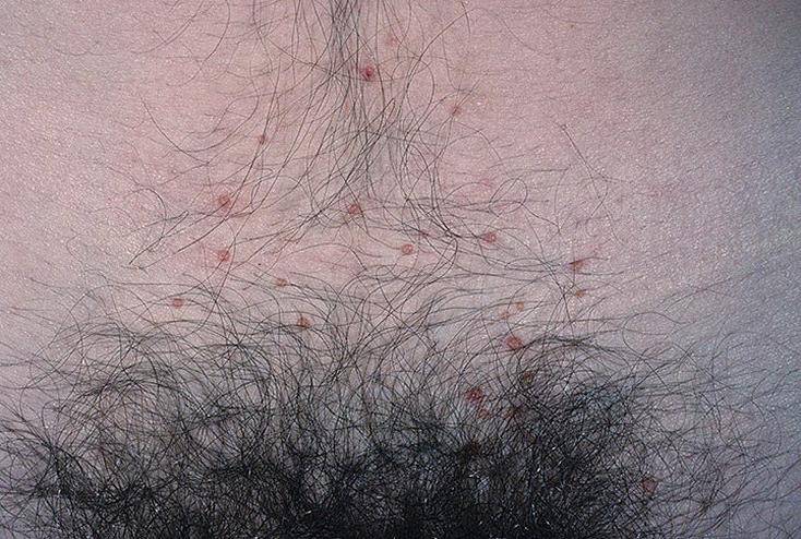 Контагиозный моллюск у детей: фото на коже, лечение и удаление на разных стадиях болезни