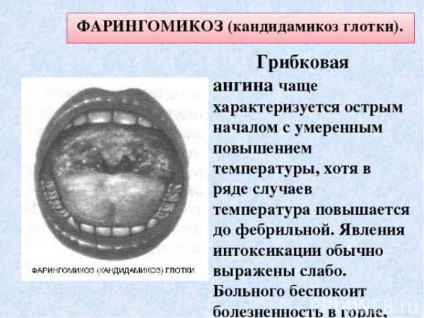 Грибковая ангина у детей