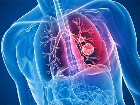 Причины хронического и рецидивирующего бронхита у детей, симптомы болезни и методы лечения