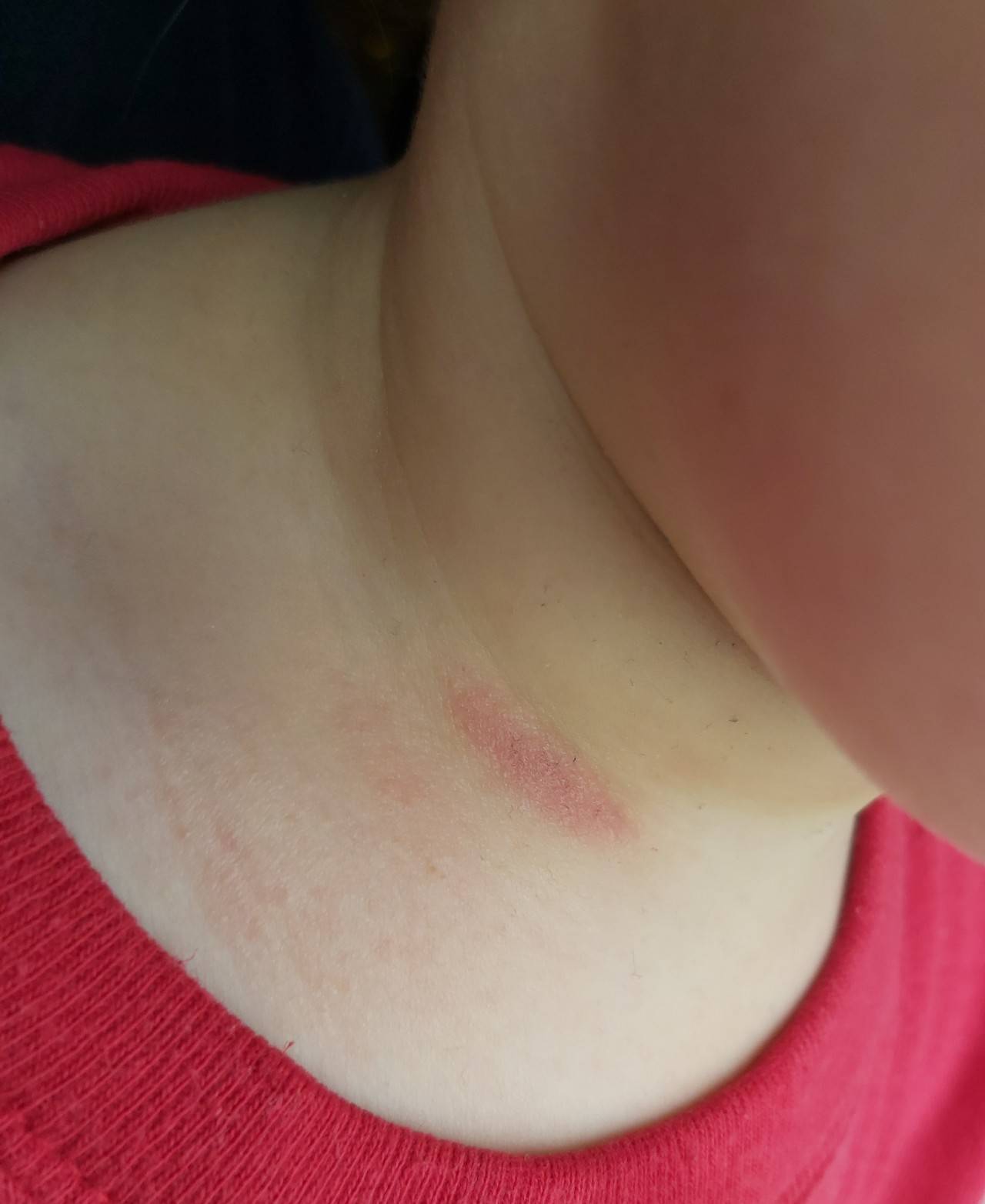 Причины появления сыпи на шее у ребенка, распространяющейся на лицо, уши и плечи