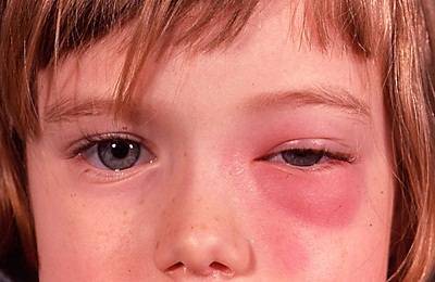 Гайморит у детей: симптомы и лечение в домашних условиях антибиотиками и народными средствами