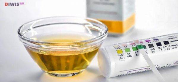 Что означает повышение глюкозы в моче у ребенка: причины и способы коррекции