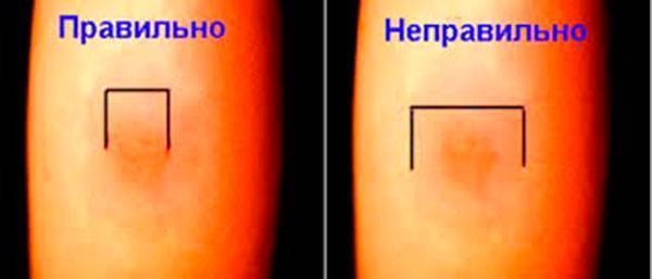 Реакция Манту у детей: норма размеров по возрасту в 1-3 года с фото