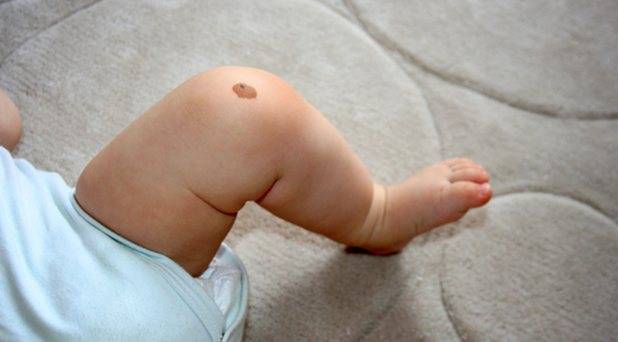 Монгольское пятно у новорожденных (монголоидное): фото, причины, значение