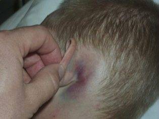 У ребенка опухла шея с одной стороны под ухом: причины, сопутствующие симптомы и лечение