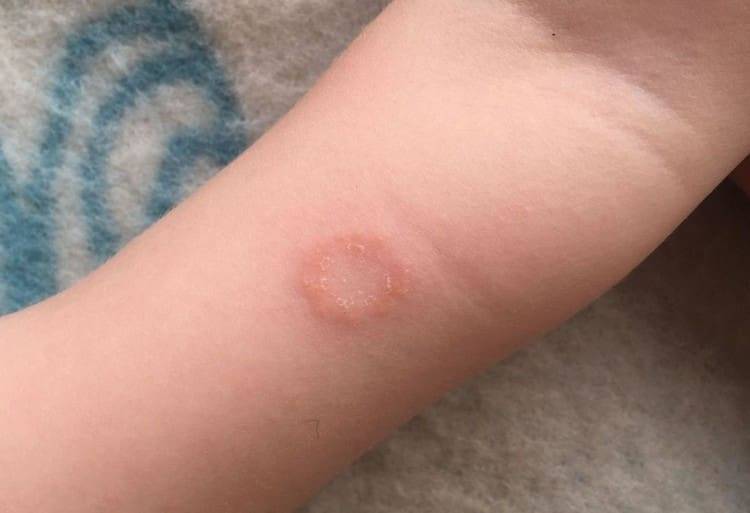 Стригущий лишай у детей на голове: фото, признаки и лечение в домашних условиях