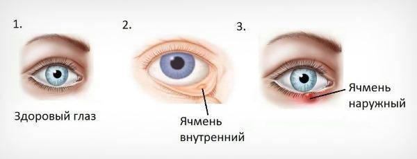 Как лечить ячмень на глазу у ребенка в домашних условиях: быстрые способы терапии чирей