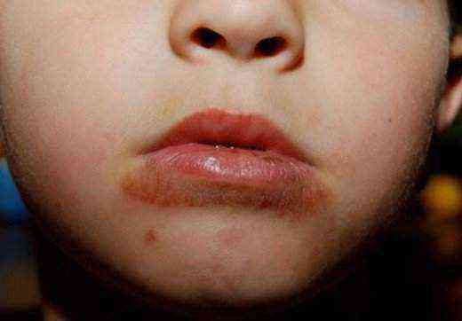 Сыпь на подбородке у ребенка: раздражение от слюней, аллергия и другие причины (фото с пояснениями)