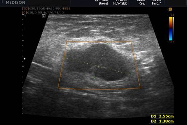 Ультразвук при лактостазе, физиотерапия: можно ли делать УЗИ при грудном вскармливании?
