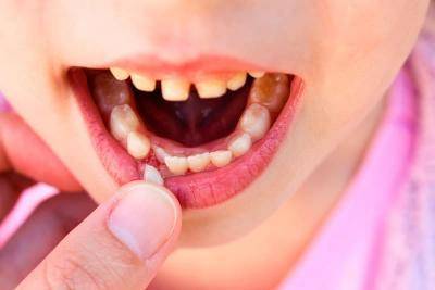 Удаление молочных зубов у детей: больно ли это и какие последствия могут быть?