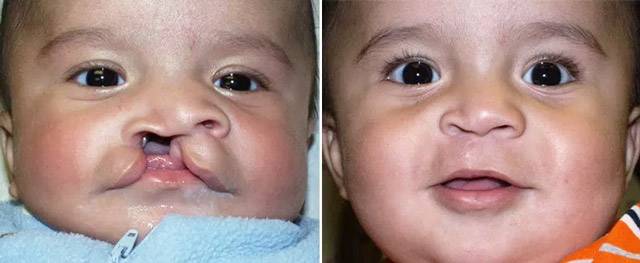 Волчья пасть у детей и заячья губа: причины патологий, фото до и после операции