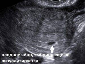 Пустое плодное яйцо или анэмбриония: причины, симптомы и методы диагностики отсутствия эмбриона
