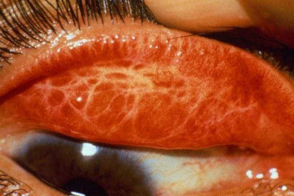 У ребенка красные глаза: причины и лечение, сопутствующие симптомы - гной, аллергия