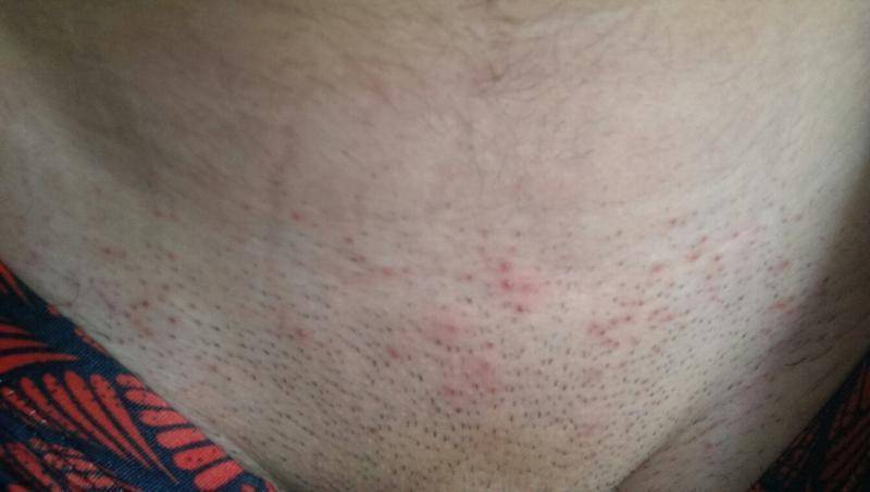 Сыпь на пенисе новорожденного