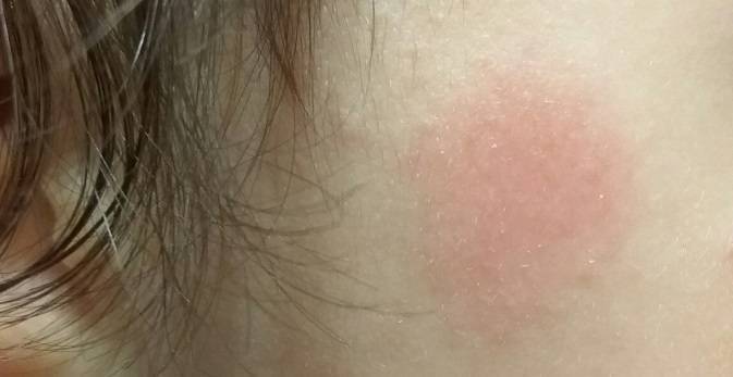 Шершавые пятна на теле у ребенка (на коже ног и рук, на спине и лице): фото