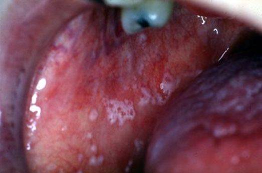 Сухость во рту у детей - причины дискомфорта, способы лечение ксеростомии