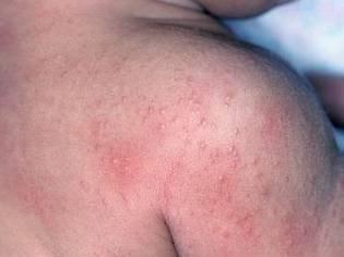 Аллергия у ребенка: фото, симптомы и лечение, профилактика кожных аллергических реакций