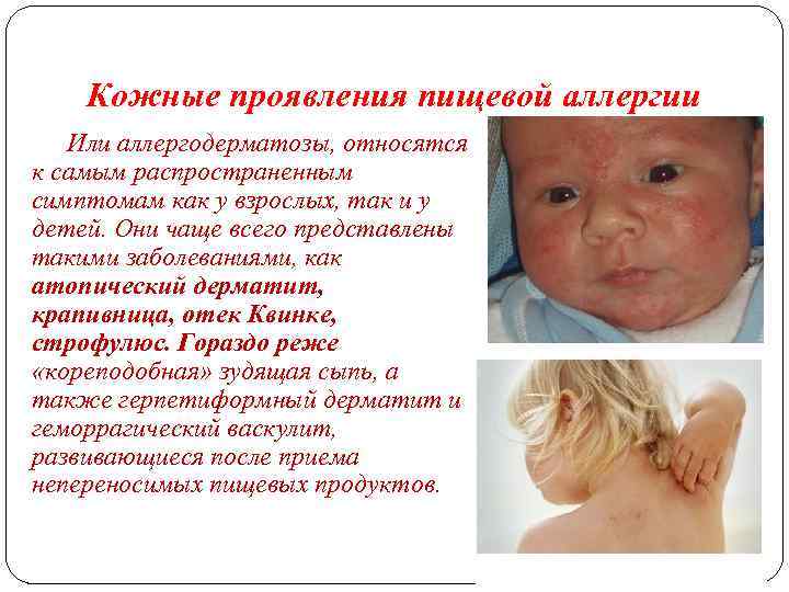 Гастроинтестинальные проявления пищевой аллергии у детей - об алкоголе