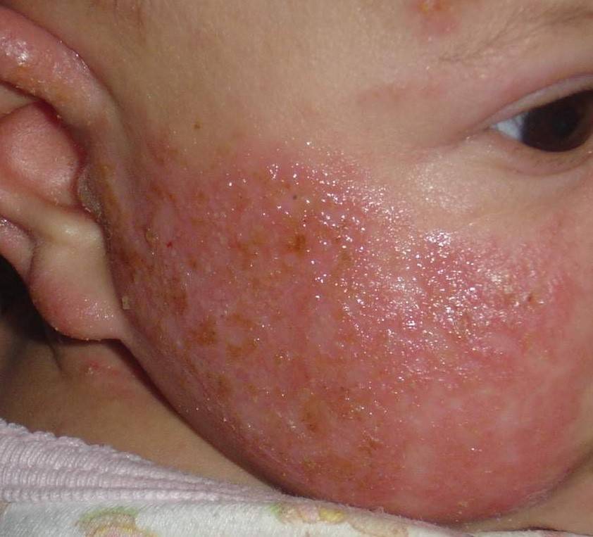 Аллергия на солнце у детей: фото, симптомы, лечение сыпи у грудничка и ребенка от 1 года