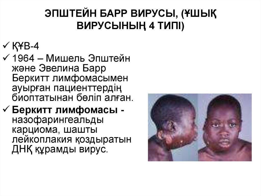 Эпштейна-барр вирусная инфекция у детей и взрослых