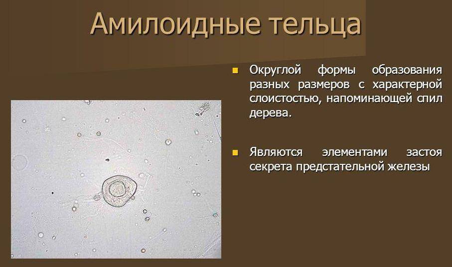 Липоидные тельца в спермограмме, макрофаги, кристаллы спермина и другие объекты в сперме