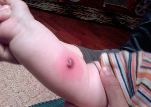 Как уменьшить Манту на руке в домашних условиях - можно ли мазать "Фенистилом" и другими средствами?