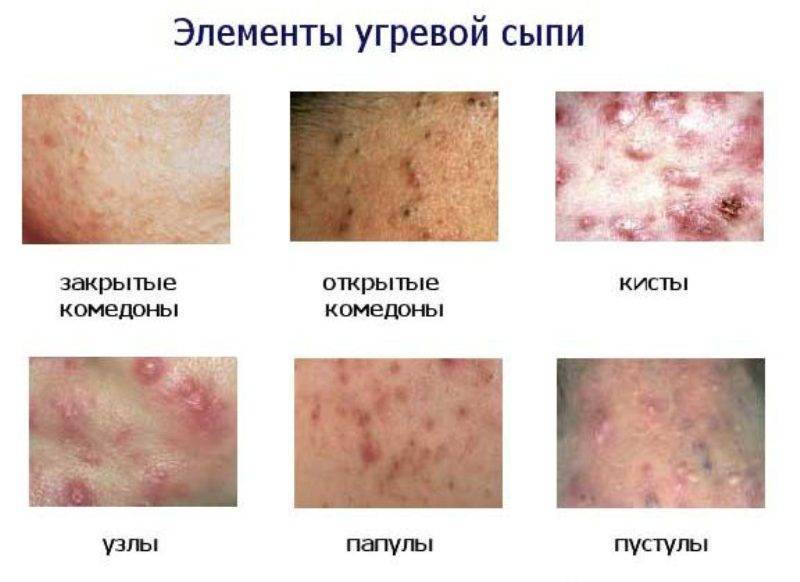 После родов прыщи на лице: почему появляются акне и сыпь и что делать?