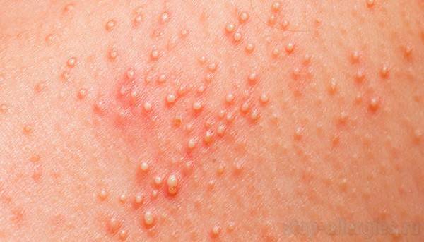 Сыпь у ребенка на попе - фото прыщей с пояснениями, причины аллергии и сухой кожи, лечение