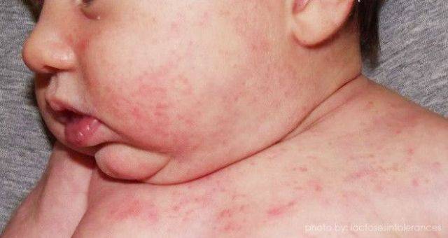 Аллергия на антибиотики у ребенка - фото сыпи от приема лекарств, лечение