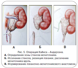 Гидронефроз при беременности: причины, симптомы, лечение, риски