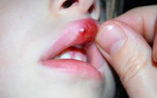 У ребенка опухла губа: причины, сопутствующие симптомы и лечение