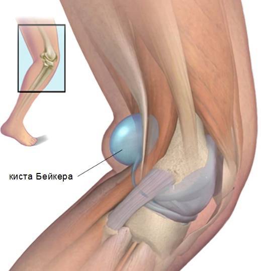 Шишка на ноге у ребенка сбоку стопы: фото гигромы и других образований