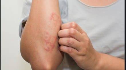 Средства для увлажнения кожи ребенка - лечение атопического дерматита народной медициной