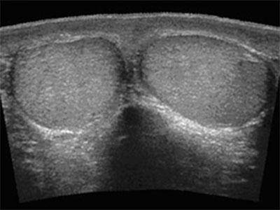 Сняли швы после гидатиды. перекрут гидатиды яичка, последствия, послеоперационный период, причины