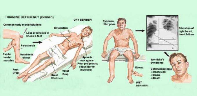 Что такое кардиопатия и кардиомиопатия у детей: причины, симптомы и лечение