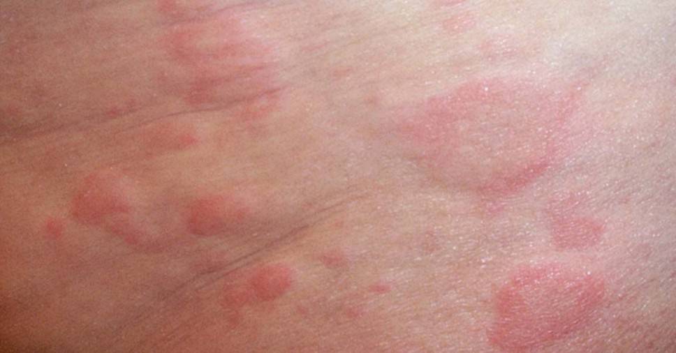 Сыпь после температуры у ребенка: фото, причины и лечение (Комаровский)