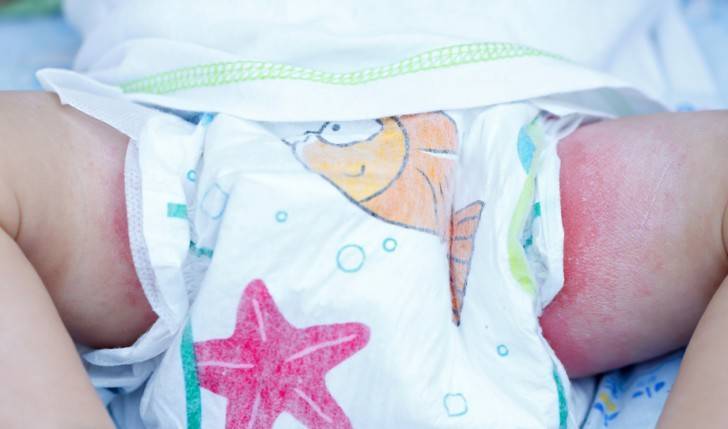 Сыпь в паху у ребенка - раздражение в интимной зоне, покраснение и зуд на половых органах