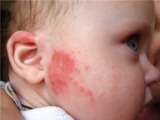 Аллергия у ребенка: фото, симптомы и лечение, профилактика кожных аллергических реакций