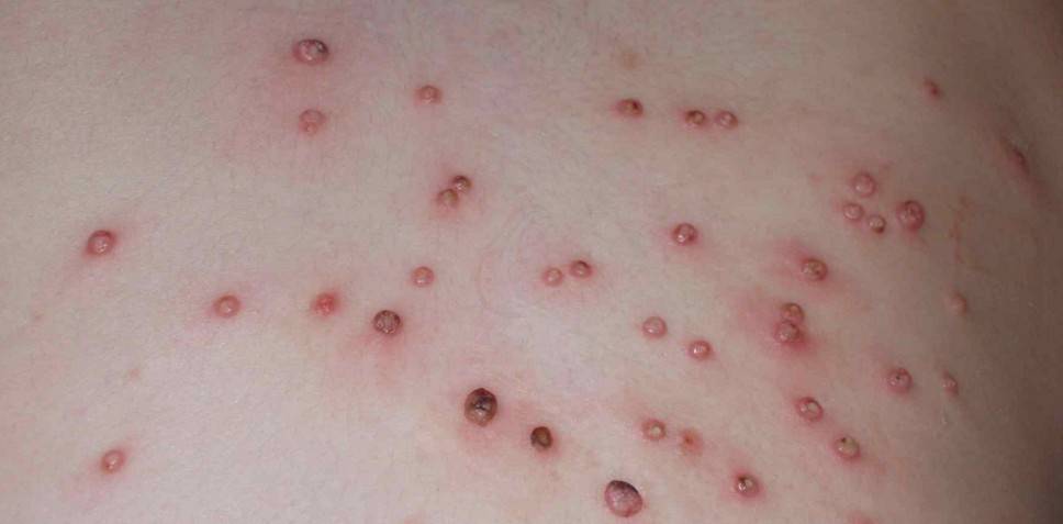 Сыпь после температуры у ребенка: фото, причины и лечение (Комаровский)