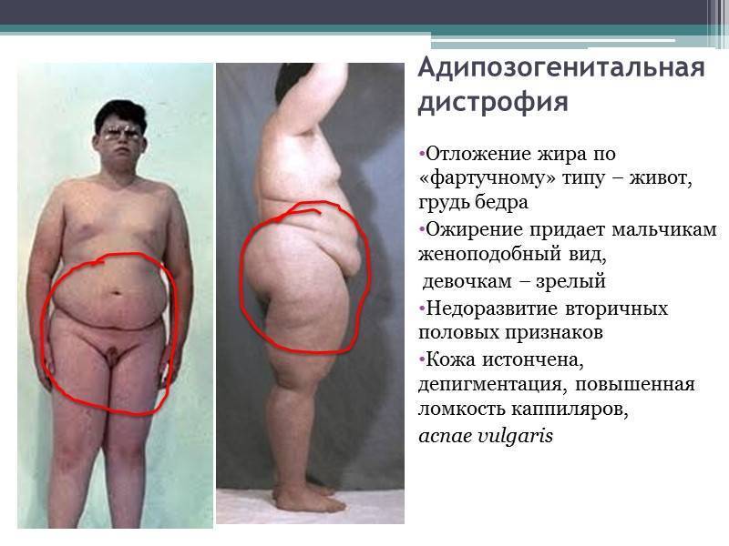 Ожирение у детей разной степени: фото, таблица по возрасту, профилактика и лечение