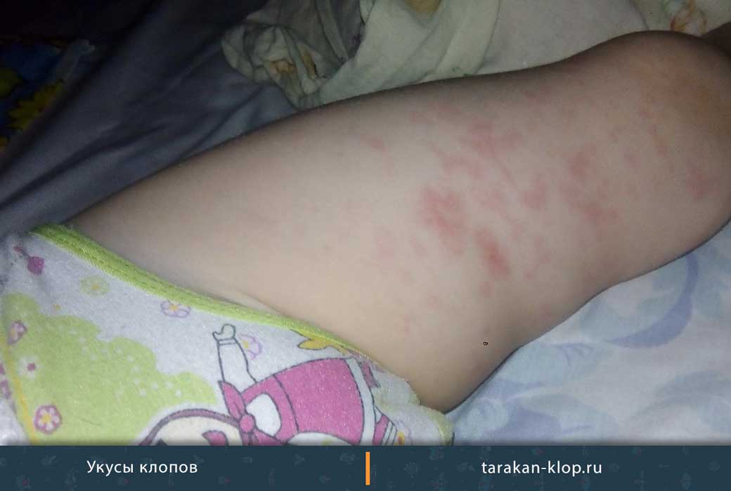 Укусы клопов у детей: фото, симптомы с описанием следов на теле малыша