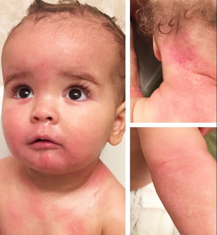 Как узнать на что аллергия у ребенка: способы определения потенциального аллергена