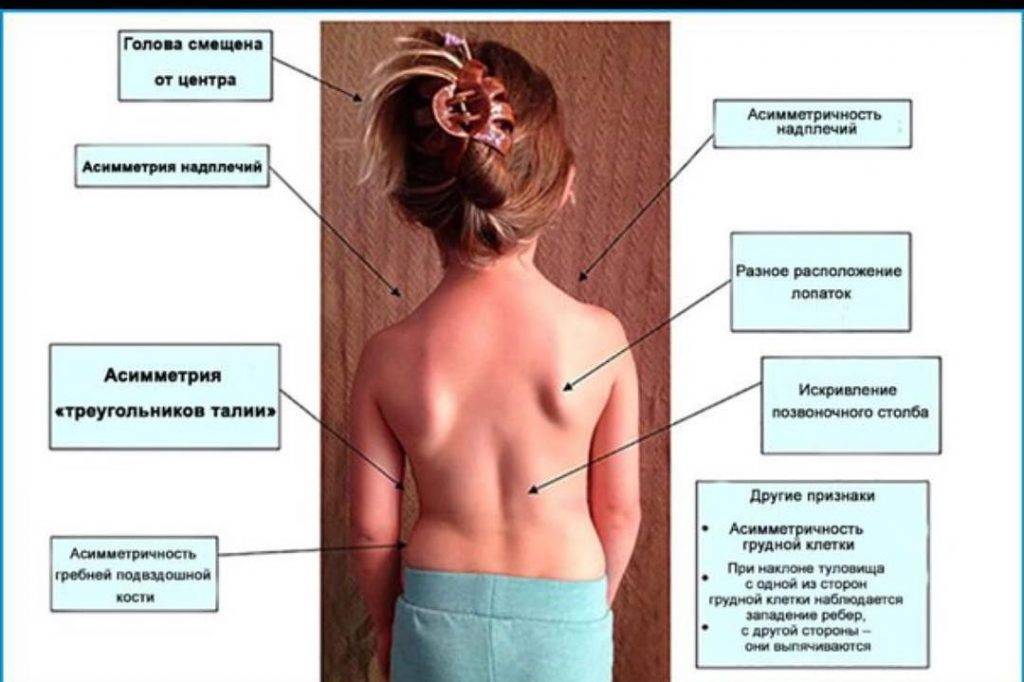 Методы лечения сколиоза у детей и профилактика искривления позвоночника