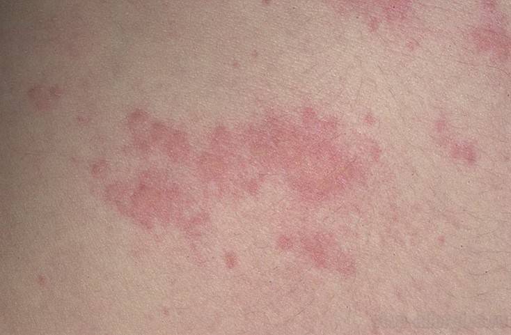 Аллергия у ребенка: фото, симптомы и лечение, профилактика кожных аллергических реакций