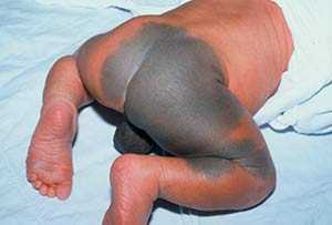 Монгольское пятно у новорожденных (монголоидное): фото, причины, значение